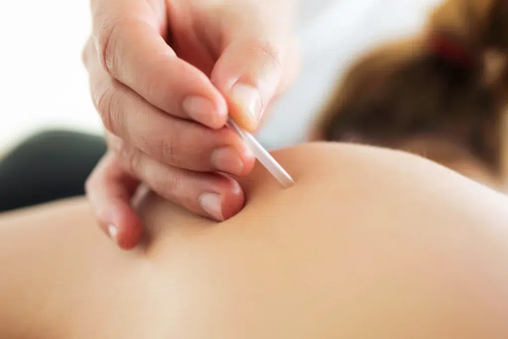 Practitioner inserting an acupuncture needle into a patient's back, the timed one-on-one contact that acupuncture CPT codes and billing services are based on