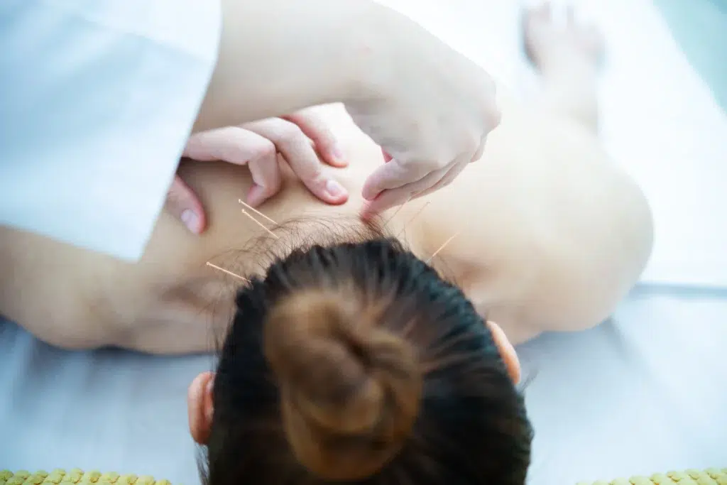 Close-up of a practitioner placing fine acupuncture needles in a patient's face, the kind of treatment documented for accurate acupuncture billing